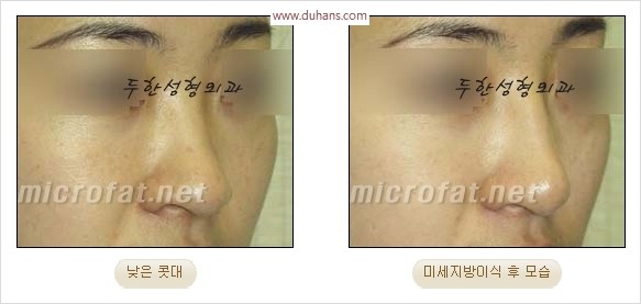 [두한성형외과 경쟁력 코성형 리더] - [자연스럽고 오똑한 콧망울! 코성형 방법]​ 관련 이미지 51