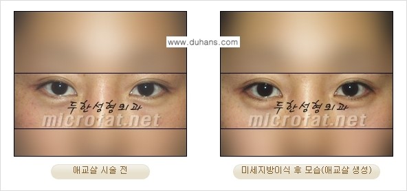 [두한성형외과 무한 경쟁력 눈밑성형] - [애교살 시술 1.] 관련 이미지 5