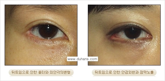 [두한성형외과 경쟁력 눈성형] - [뒤트임 수술 부작용 안내] 관련 이미지 9