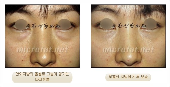 [두한성형외과 쌍커풀수술] - [눈성형 방법에 대한 자주하는 질문과 답변] 관련 이미지 158
