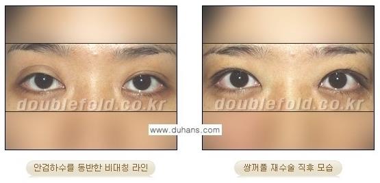 [두한성형외과 경쟁력 쌍꺼풀 재수술, 극한 눈재수술] - [망친 쌍꺼풀, 망가진 쌍꺼풀 복원수술, 재수술의 성공요건] 관련 이미지 3