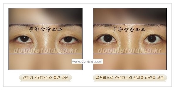 [두한성형외과 경쟁력 쌍꺼풀 재수술, 극한 재수술] - [안검하수(졸린눈매) 교정 방법 안내] 관련 이미지 5