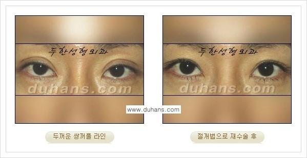 [두한성형외과 경쟁력 쌍꺼풀 재수술, 극한 재수술] - [두꺼운 쌍꺼풀 라인의 교정 방법 안내] 관련 이미지 7