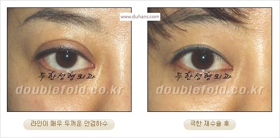 [두한성형외과 경쟁력 쌍꺼풀 재수술 스페셜] - [망가진 라인을 교정하는 극한 재수술] 관련 이미지 16