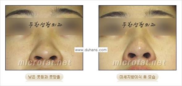 ​[두한성형외과의 No.1 경쟁력 미세(자가)지방이식] - [코높힘 미세(자가)지방이식 ②] 관련 이미지 3