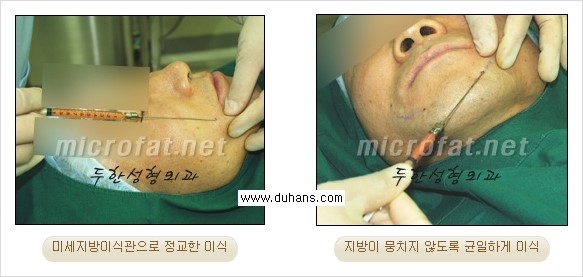 [두한성형외과 경쟁력 미세지방이식] - [Dr. 컬럼 "미세지방이식 클리닉의 특징과 자부심"] 관련 이미지 6