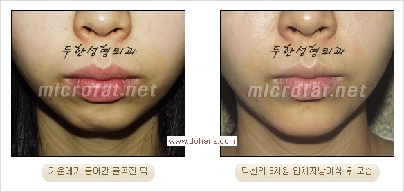 [두한성형외과 경쟁력 미세지방이식] - [부드럽고 아름다운 얼굴윤곽선 턱(하악부) 미세지방이식 안내] 관련 이미지 16