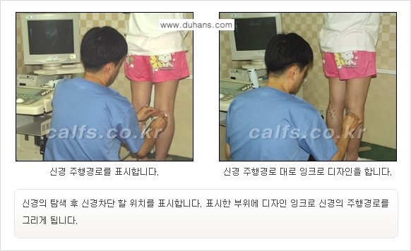 [두한성형외과 경쟁력 멀티종아리성형] - [종아리성형 방법별 전후 주의사항] 관련 이미지 5