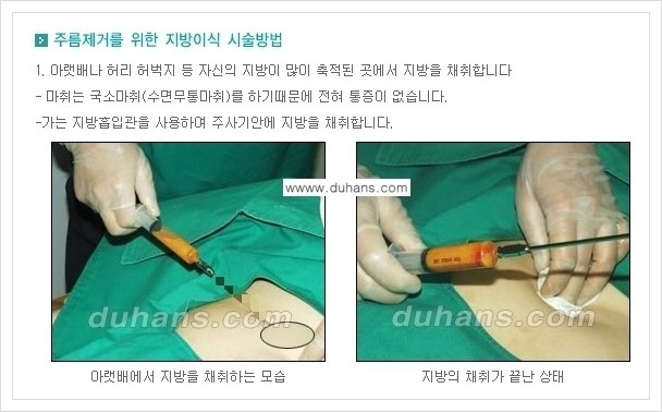 ​[두한성형외과 경쟁력 주름성형] - [주름교정을 위한 미세지방이식 안내 1.] 관련 이미지 7