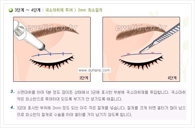 [두한성형외과 경쟁력 눈성형] - [퀵쌍꺼풀 수술] 관련 이미지 3