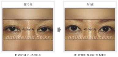 두한성형외과 쌍커풀 재수술 - 짝눈 눈매교정, 가성 안검하수 교정과 뒤밑트임 관련 이미지 39