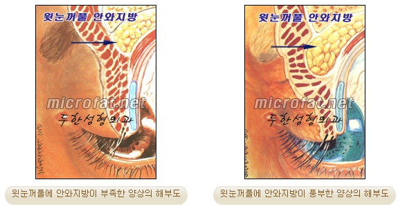 [Doohan Plastic Surgery Autologous Fat Grafting] - [Sunken Eye Fat Grafting] image 3