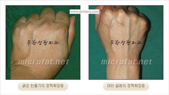 [두한성형외과 경쟁력 정맥류 치료] - [손, 손등, 손목혈관확장증, 팔혈관확장증에 질문과 답변] 관련 이미지 2