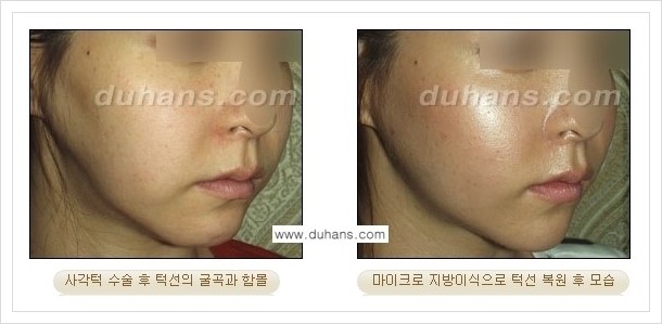 [두한성형외과 경쟁력 얼굴 미세지방이식] - [타병원에서 지방이식 후 굴곡과 과주입 교정 안내] 관련 이미지 6