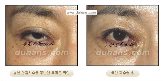 [두한성형외과 경쟁력 눈성형] - [두꺼운 라인을 교정하는 극한 눈 재수술 1.] 관련 이미지 6
