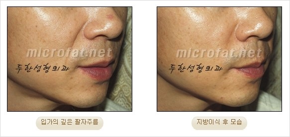 [두한성형외과 경쟁력 안티에이징 동안성형] - [주름이 깊은 푹~ 꺼진 입가 팔자주름 안녕!] 관련 이미지 29