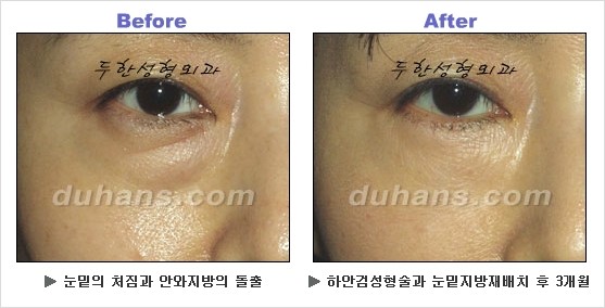 [두한성형외과 경쟁력 동안성형 리더] - ​[미간주름, 이마주름, 안검성형, 이마거상술, 눈썹거상술] 관련 이미지 67