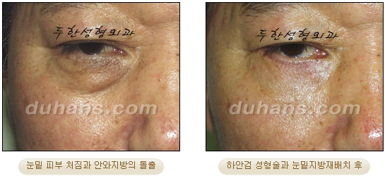 [Duhan Plastic Surgery Ophthalmic Plastic Surgery] - [Lower Blepharoplasty] image 15