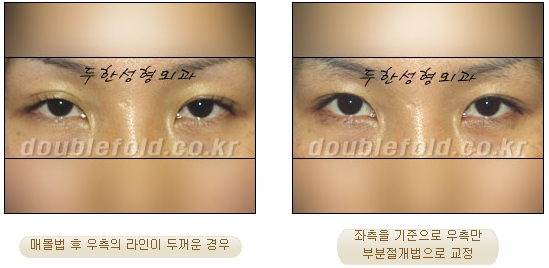 [두한성형외과 눈재수술] - [부분절개법 재수술] 관련 이미지 40