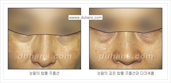 ​[두한성형외과 경쟁력 주름성형] - [주름교정을 위한 미세지방이식 안내 1.] 관련 이미지 4