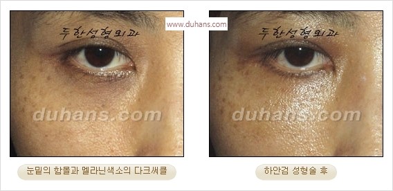[두한성형외과 경쟁력 안검성형] - [눈밑주름 제거수술] 관련 이미지 17