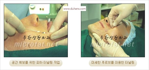 [두한성형외과 경쟁력 안면윤곽 교정] - [자연스럽고 균형있는 턱으로의 복원 미세지방이식과 간편 사각턱 보톡스 안내] 관련 이미지 32