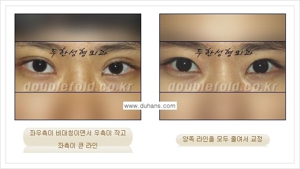 [두한성형외과 경쟁력 쌍꺼풀 재수술] - [짝짝이(비대칭) 쌍꺼풀 라인 교정하는 방법 안내 2.] 관련 이미지 6