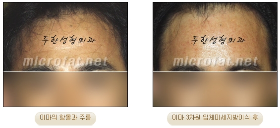[두한성형외과 자가지방이식] - [미세지방이식 안내] 관련 이미지 8