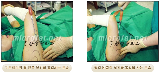 두한성형외과 지방흡입 - 부위별 안전 지방흡입 관련 이미지 10