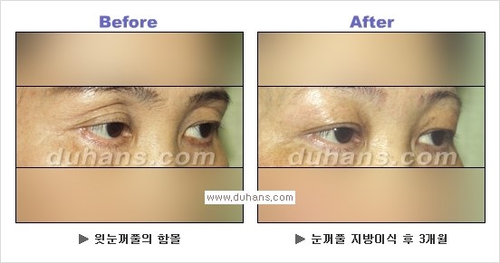 [두한성형외과 경쟁력 눈성형] - [상큼하고 환한 눈매! 상안검 성형(윗눈꺼풀 처짐) 안내] 관련 이미지 8
