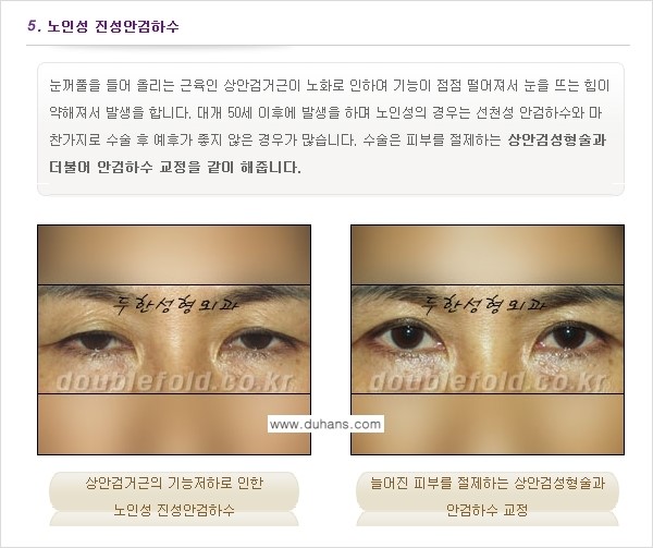 [두한성형외과 NO.1 "극한 눈(쌍꺼풀 재수술)"] - [안검하수(졸린눈매) 재수술 안내 1.] 관련 이미지 8