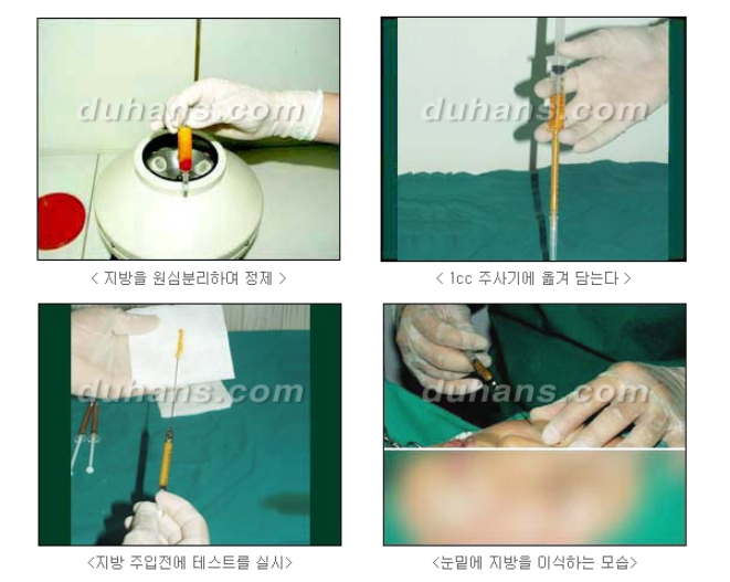 눈밑 다크써클 개선 원리 관련 이미지 7