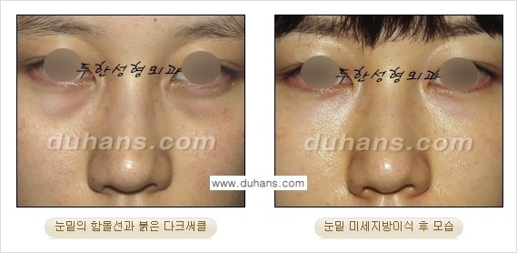 [두한성형외과 경쟁력 미세지방이식] - [다크써클 & 눈밑주름 미세지방이식 3.] 관련 이미지 7