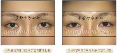 [두한성형외과 쌍커풀수술] - [쌍꺼풀지방이식] 관련 이미지 12