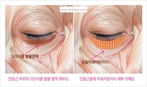 [두한성형외과 경쟁력 눈밑성형] - [눈밑 미세지방이식의 이해도 안내] 관련 이미지 12