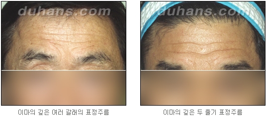 [두한성형외과 주름교정] - [주름개선 지방이식] 관련 이미지 4