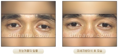 [Duhan Plastic Surgery Micro Fat Grafting] - [Upper Eyelids] image 8