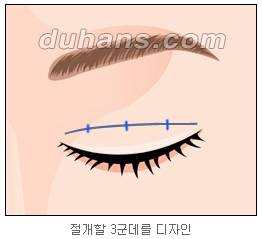쌍커풀수술 두한성형외과 - 나에게 맞는 눈성형은? 관련 이미지 18