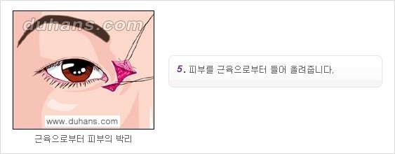 [두한성형외과 NO.1 눈성형] - [몽고주름 제거(앞트임 수술) 2.] 관련 이미지 6