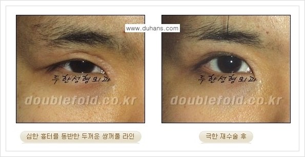 [두한성형외과 경쟁력 쌍꺼풀 재수술] - [극한의 상태에서 쌍꺼풀 재수술 안내 ②] 관련 이미지 7