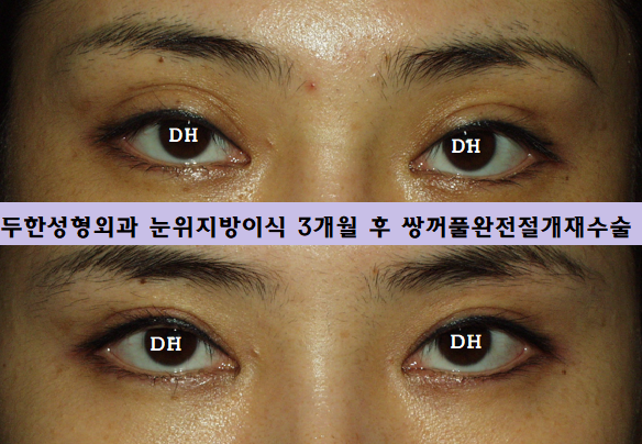 눈위 지방이식 후 쌍꺼풀재수술 만족후기!! 관련 이미지 1