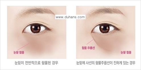 [두한성형외과 경쟁력 다크써클 치료] - [다크써클 5단계로 이뤄지는 핵심 5 STEP SOLUTION 안내 1.] 관련 이미지 4