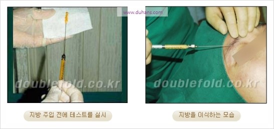 [두한성형외과 경쟁력 눈성형] - [쌍꺼풀 재수술 과정과 쌍꺼풀 재수술 실패의 원인, 쌍꺼풀 재수술의 성공 요건] 관련 이미지 23