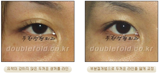 [두한성형외과 눈재수술] - [부분절개법 재수술] 관련 이미지 36