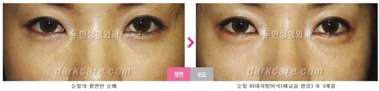 [두한성형외과 다크서클] - [다크서클 전후사진 검증] 관련 이미지 48