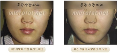 Facial Fat Liposuction at Duhan Plastic Surgery - Cheek Fat Liposuction, Jawline Liposuction, Under-Eye Fat Liposuction image 22