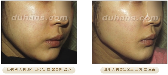 [두한성형외과 얼굴자가지방이식] - [볼살, 이마, 측두부] 관련 이미지 41