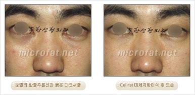 두한성형외과 눈밑수술 - 다크서클 수술 전후 관리 안내 관련 이미지 15