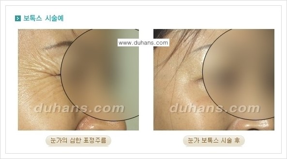[두한성형외과 경쟁력 주름성형] - [얼굴 주름제거 보톡스 안내] 관련 이미지 5