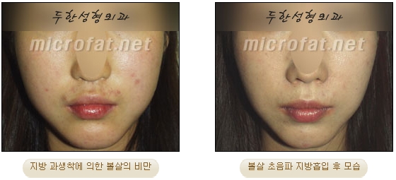 [Duhan Plastic Surgery Liposuction] - [Facial Liposuction] image 35